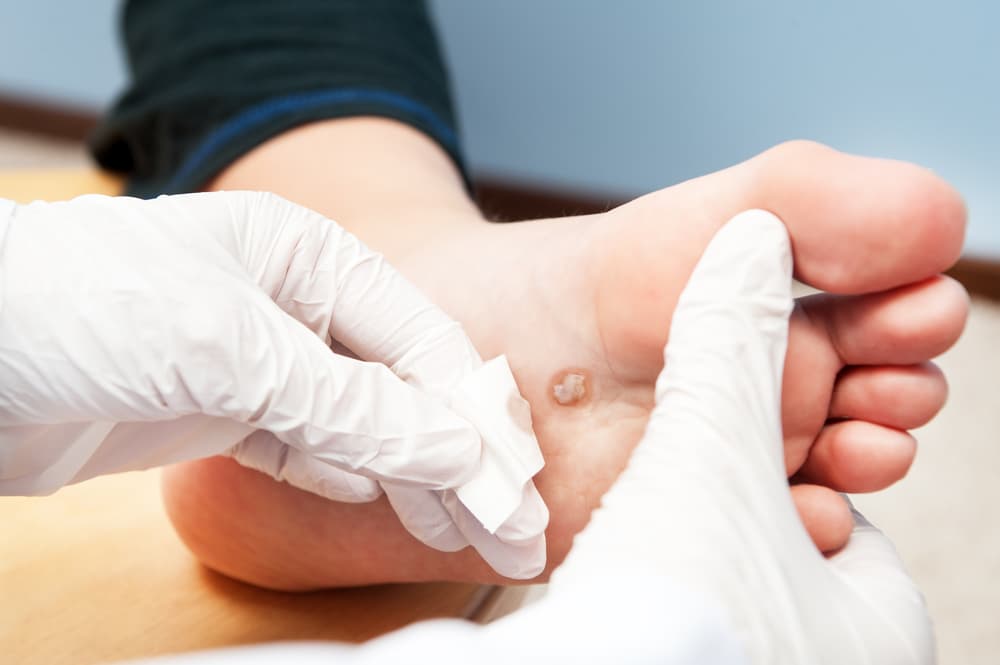 Wart Treatment in New York City